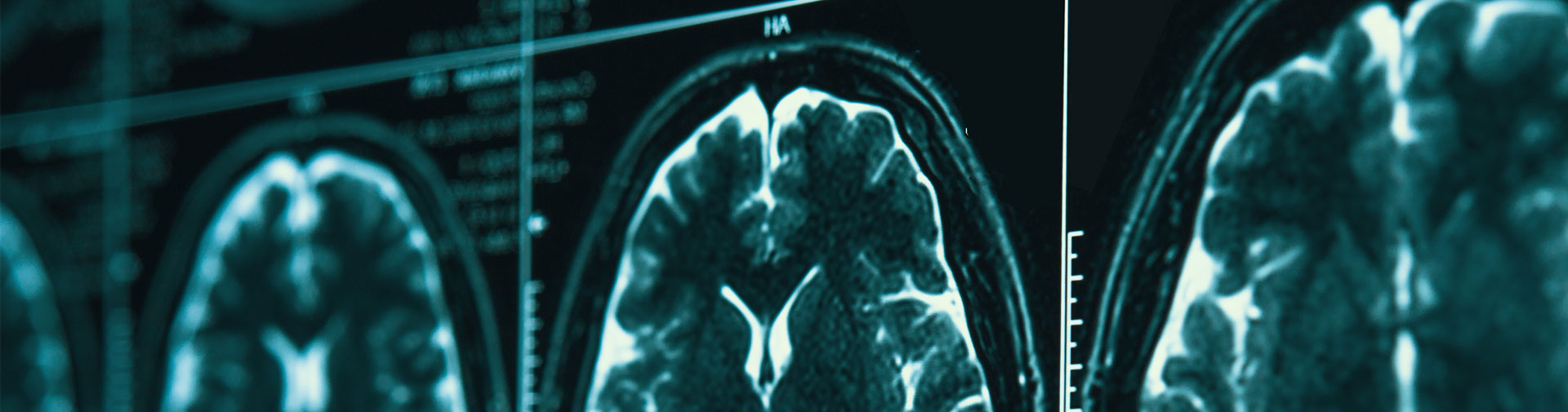 Brain injury claims Solicitors Accrington